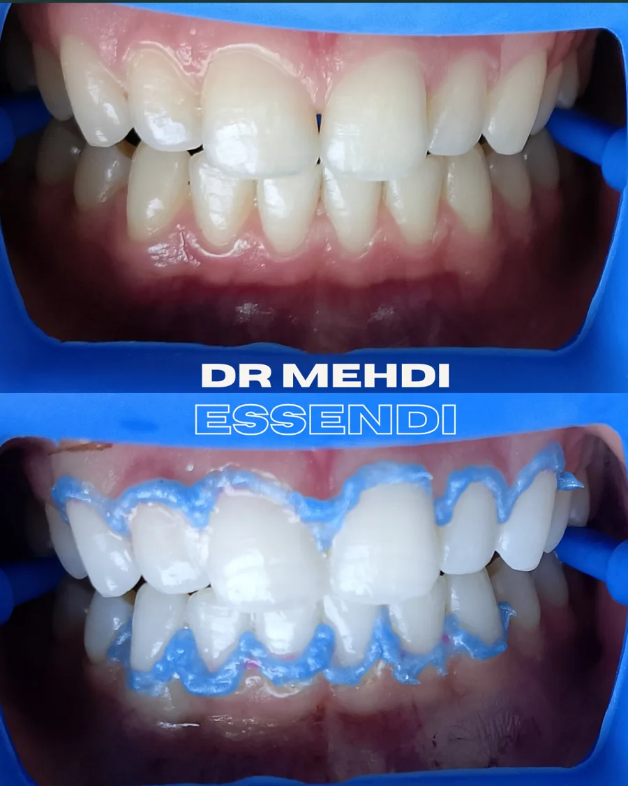 Comparaison clinique pendant un protocole de blanchiment dentaire