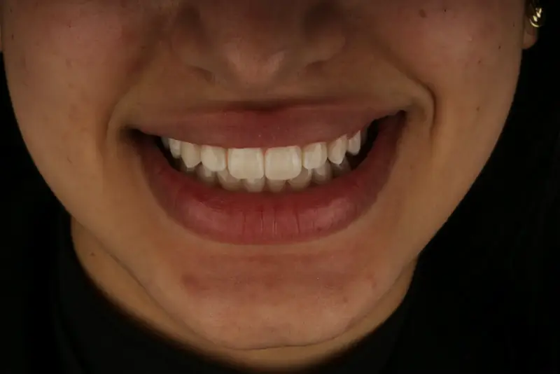 Harmonisation du sourire, après le traitement