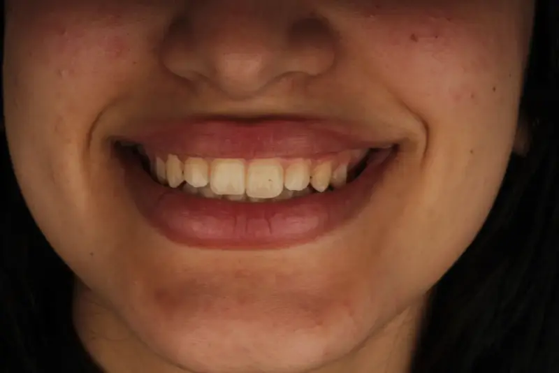 Harmonisation du sourire, avant le traitement