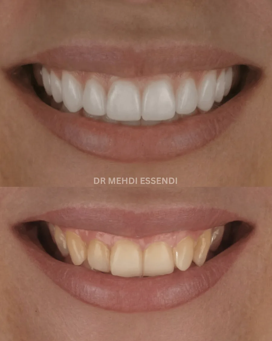Comparaison d’un sourire avant et après un projet de facettes