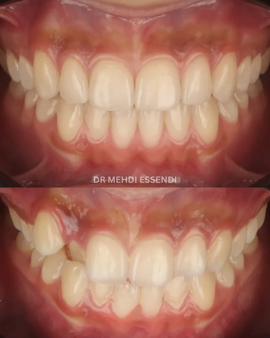 Comparaison clinique avant et après un traitement orthodontique